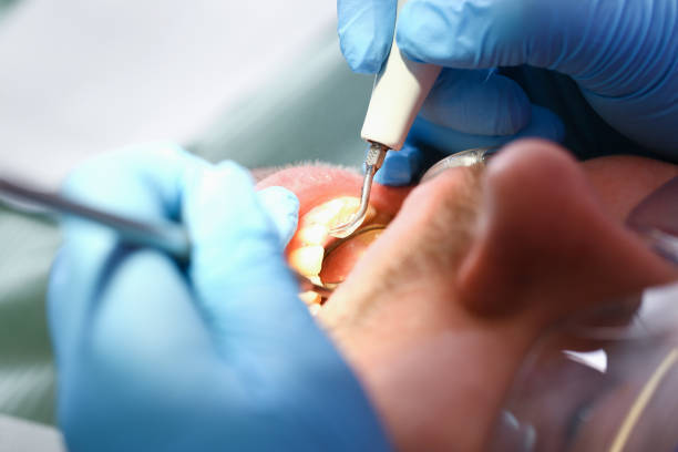 Best Knocked-Out Tooth (Avulsed Tooth) Treatment in Lanse, MI